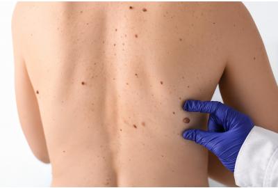 Your Guide to Seborrhoeic Keratosis: From Causes to Care